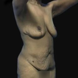 Breast Lift Before & After Patient #169