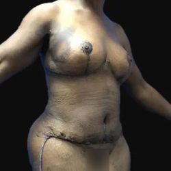 Breast Lift Before & After Patient #169