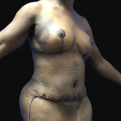 Breast Lift Before & After Patient #169