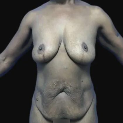 Breast Lift Before & After Patient #169