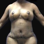Breast Lift Before & After Patient #169