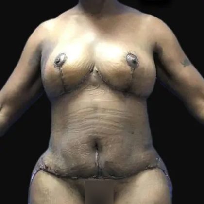Breast Lift Before & After Patient #169