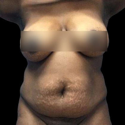 Abdominoplasty Before & After Patient #176