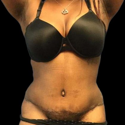 Abdominoplasty Before & After Patient #176