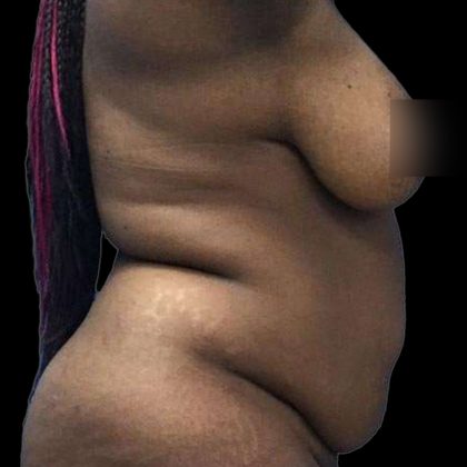 Abdominoplasty Before & After Patient #176