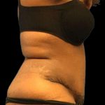 Abdominoplasty Before & After Patient #176
