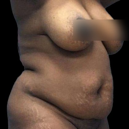 Abdominoplasty Before & After Patient #176