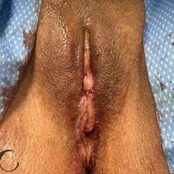 Labiaplasty Before & After Patient #237