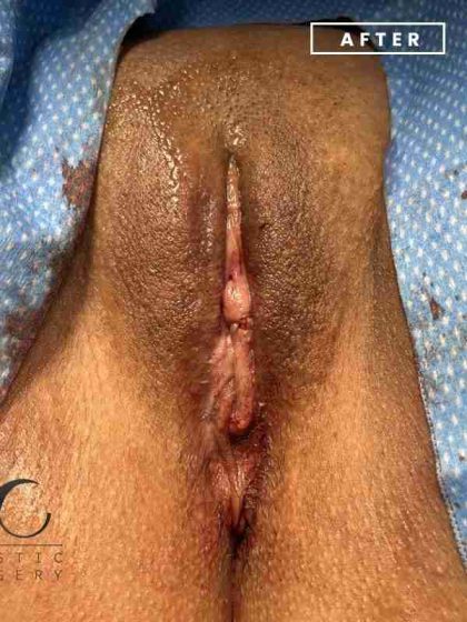 Labiaplasty Before & After Patient #237