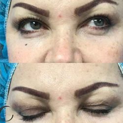 Blepharoplasty Before & After Patient #67
