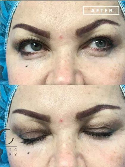 Blepharoplasty Before & After Patient #67