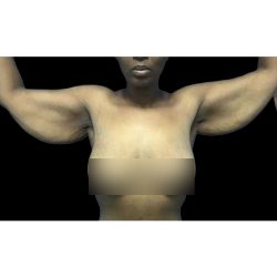 Arm Lift Before & After Patient #164