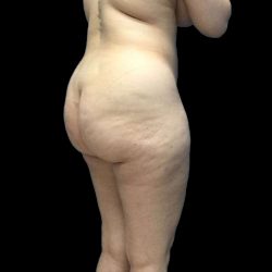Brazilian Butt Lift Before & After Patient #199