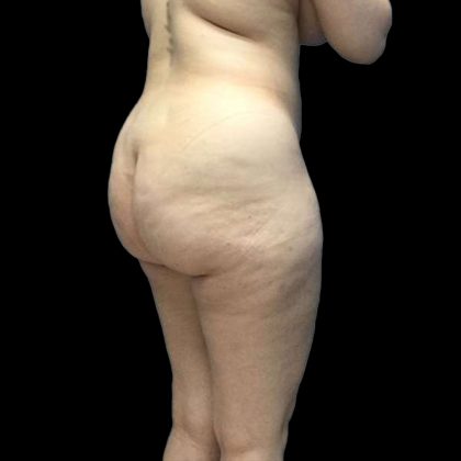Brazilian Butt Lift Before & After Patient #199