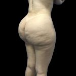 Brazilian Butt Lift Before & After Patient #199