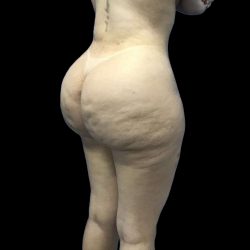 Brazilian Butt Lift Before & After Patient #199