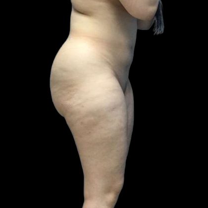 Brazilian Butt Lift Before & After Patient #199