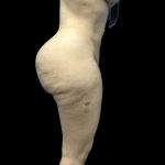 Brazilian Butt Lift Before & After Patient #199