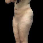 Brazilian Butt Lift Before & After Patient #199