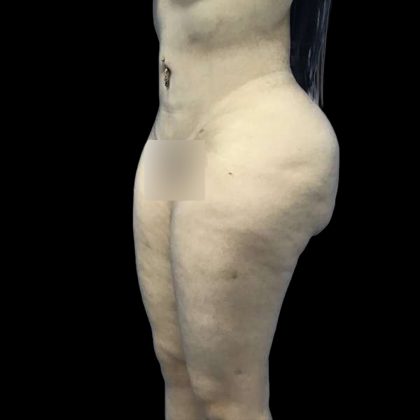 Brazilian Butt Lift Before & After Patient #199