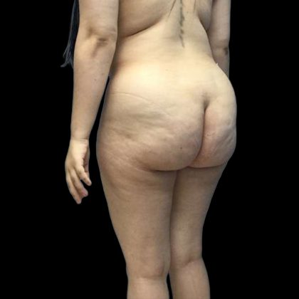 Brazilian Butt Lift Before & After Patient #199