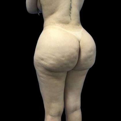 Brazilian Butt Lift Before & After Patient #199