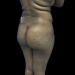 Brazilian Butt Lift Before & After Patient #208