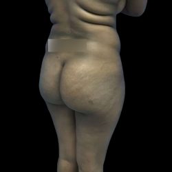 Brazilian Butt Lift Before & After Patient #208