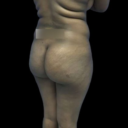 Brazilian Butt Lift Before & After Patient #208
