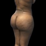 Brazilian Butt Lift Before & After Patient #208