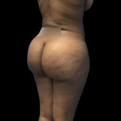 Brazilian Butt Lift Before & After Patient #208