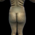 Brazilian Butt Lift Before & After Patient #208