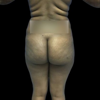Brazilian Butt Lift Before & After Patient #208