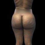 Brazilian Butt Lift Before & After Patient #208