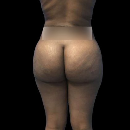Brazilian Butt Lift Before & After Patient #208