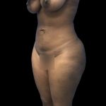 Brazilian Butt Lift Before & After Patient #208