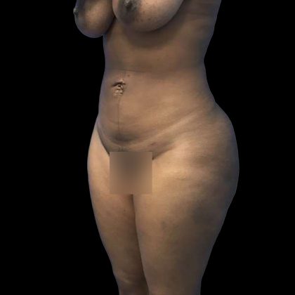 Brazilian Butt Lift Before & After Patient #208