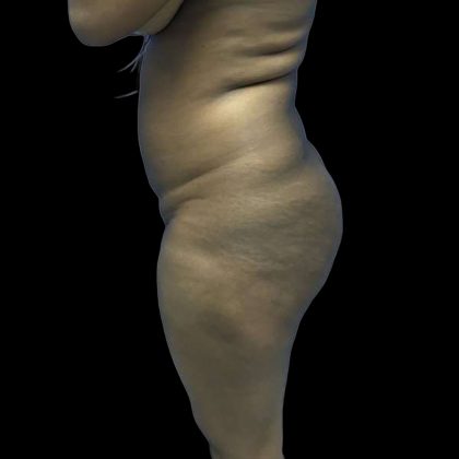 Brazilian Butt Lift Before & After Patient #208