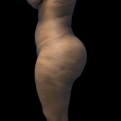 Brazilian Butt Lift Before & After Patient #208