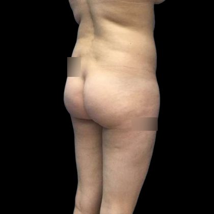 Brazilian Butt Lift Before & After Patient #219