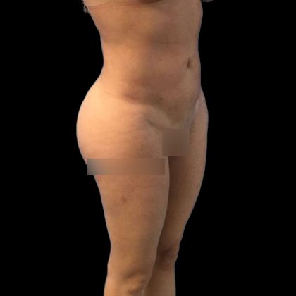 Brazilian Butt Lift Before & After Patient #219