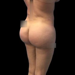 Brazilian Butt Lift Before & After Patient #219