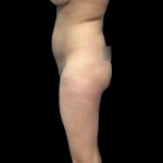 Brazilian Butt Lift Before & After Patient #219