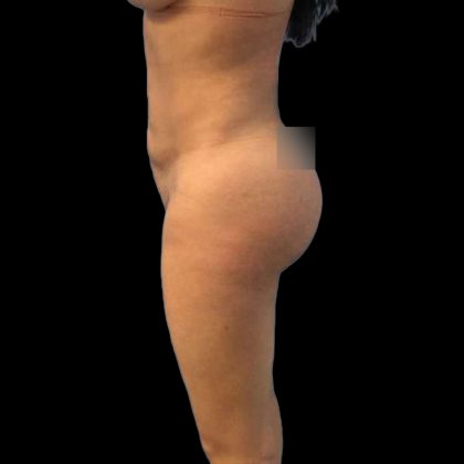 Brazilian Butt Lift Before & After Patient #219