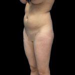 Brazilian Butt Lift Before & After Patient #219