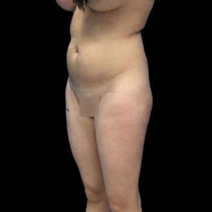 Brazilian Butt Lift Before & After Patient #219