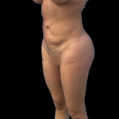 Brazilian Butt Lift Before & After Patient #219