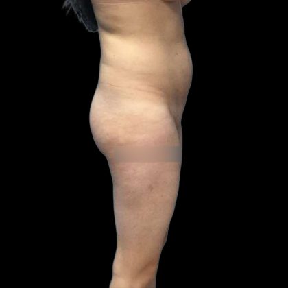 Brazilian Butt Lift Before & After Patient #219