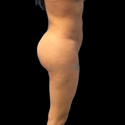 Brazilian Butt Lift Before & After Patient #219