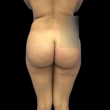 Brazilian Butt Lift Before & After Patient #228